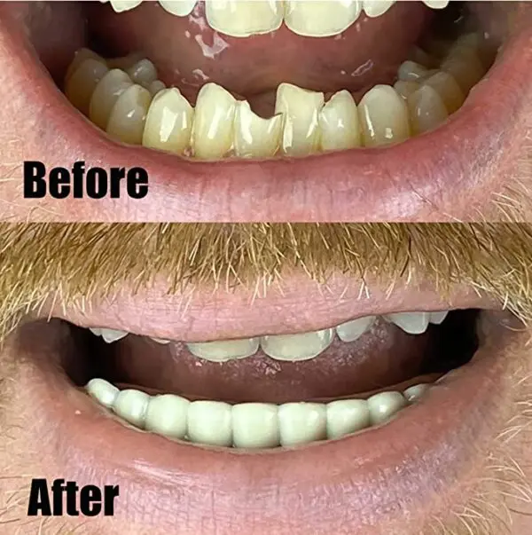 A man's teeth before and after Instant Smile Comfort Fit Flexible Lower Teeth.